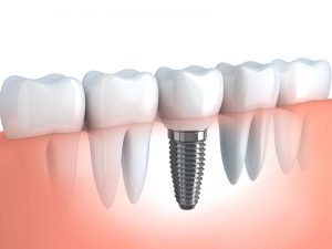 Implant Dentistry